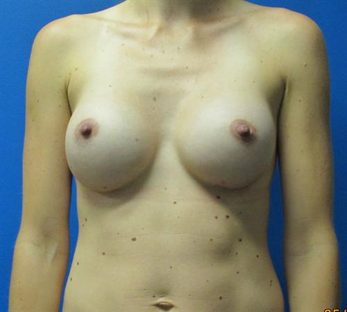 Breast Augmentation Before and After | SGK Plastic Surgery