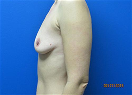 Breast Augmentation Before and After | SGK Plastic Surgery