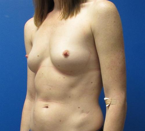 Breast Augmentation Before and After | SGK Plastic Surgery