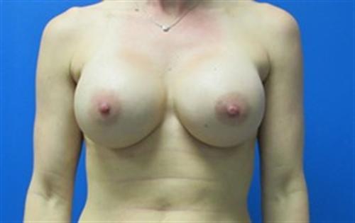 Breast Augmentation Before and After | SGK Plastic Surgery