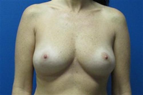 Breast Augmentation Before and After | SGK Plastic Surgery