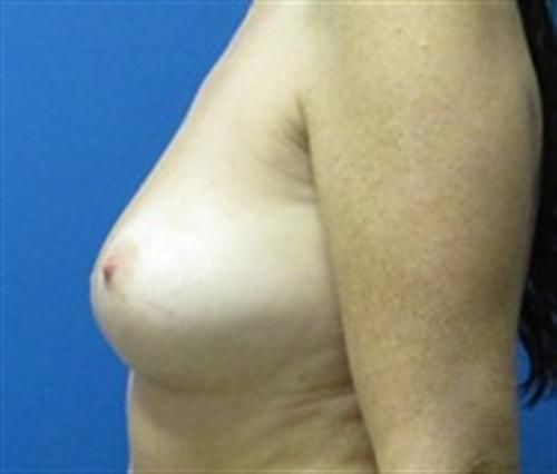 Breast Augmentation Before and After | SGK Plastic Surgery