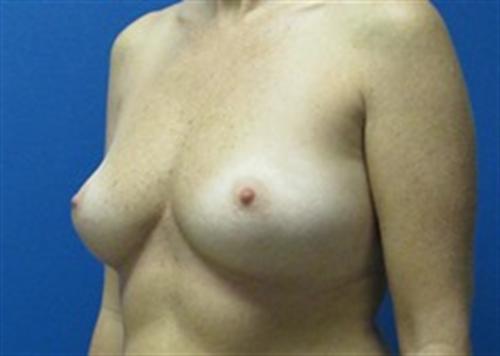 Breast Augmentation Before and After | SGK Plastic Surgery