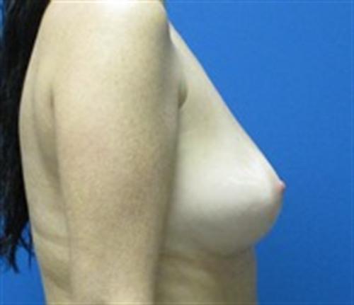 Breast Augmentation Before and After | SGK Plastic Surgery