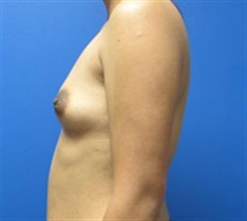 Breast Augmentation Before and After | SGK Plastic Surgery