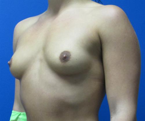 Breast Augmentation Before and After | SGK Plastic Surgery