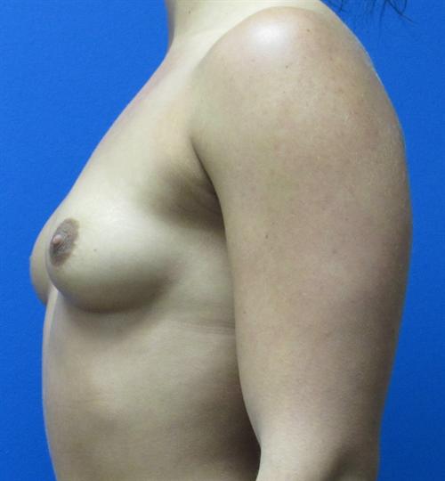 Breast Augmentation Before and After | SGK Plastic Surgery