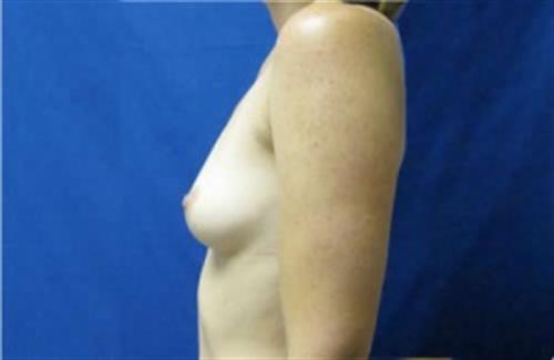 Breast Augmentation Before and After | SGK Plastic Surgery