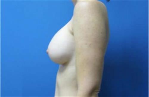 Breast Augmentation Before and After | SGK Plastic Surgery