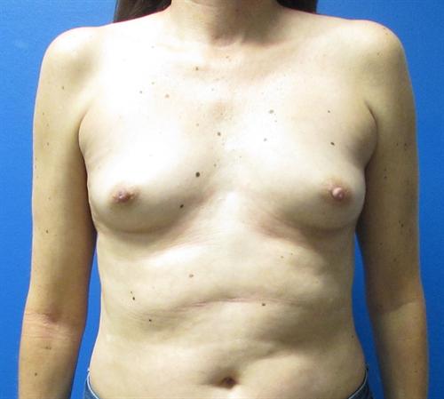 Breast Augmentation Before and After | SGK Plastic Surgery