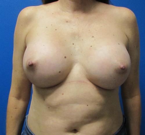 Breast Augmentation Before and After | SGK Plastic Surgery