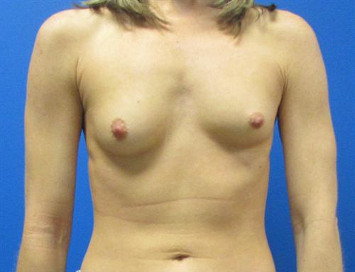 Breast Augmentation Before and After | SGK Plastic Surgery