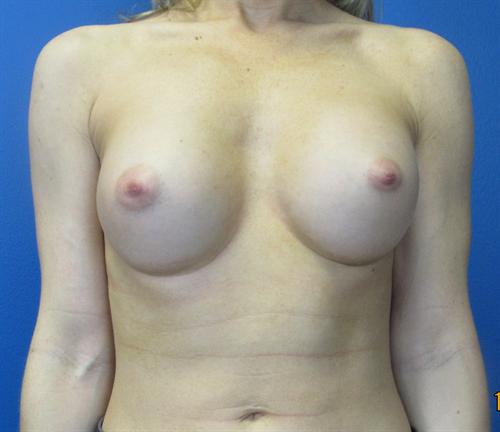 Breast Augmentation Before and After | SGK Plastic Surgery