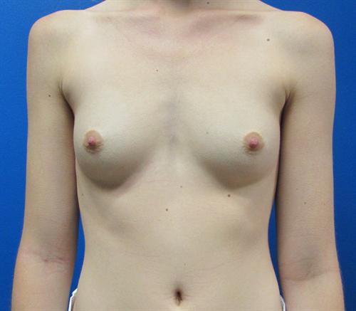 Breast Augmentation Before and After | SGK Plastic Surgery