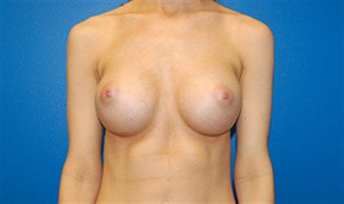 Breast Augmentation Before and After | SGK Plastic Surgery