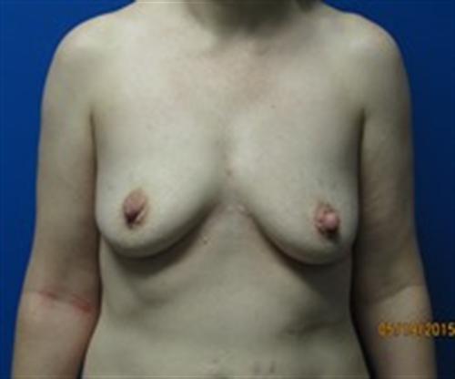 Breast Augmentation Before and After | SGK Plastic Surgery