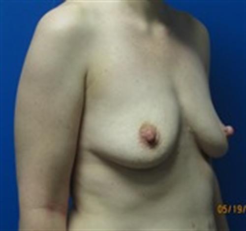 Breast Augmentation Before and After | SGK Plastic Surgery