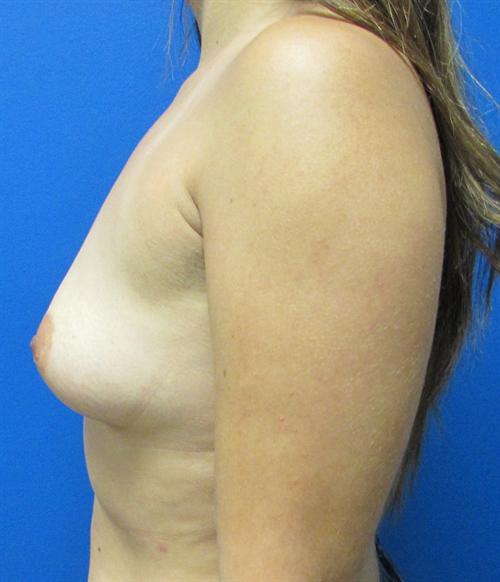 Breast Augmentation Before and After | SGK Plastic Surgery