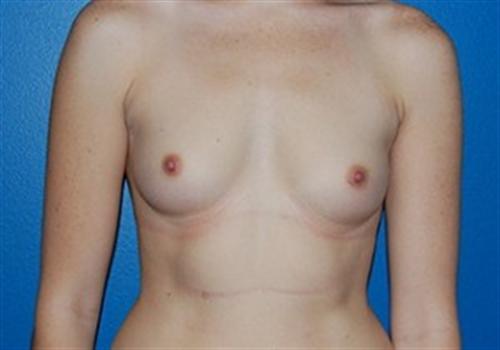 Breast Augmentation Before and After | SGK Plastic Surgery