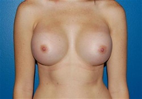 Breast Augmentation Before and After | SGK Plastic Surgery