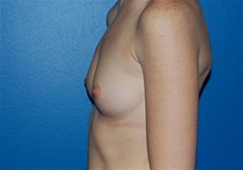 Breast Augmentation Before and After | SGK Plastic Surgery