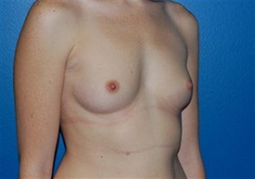 Breast Augmentation Before and After | SGK Plastic Surgery