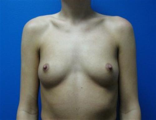 Breast Augmentation Before and After | SGK Plastic Surgery