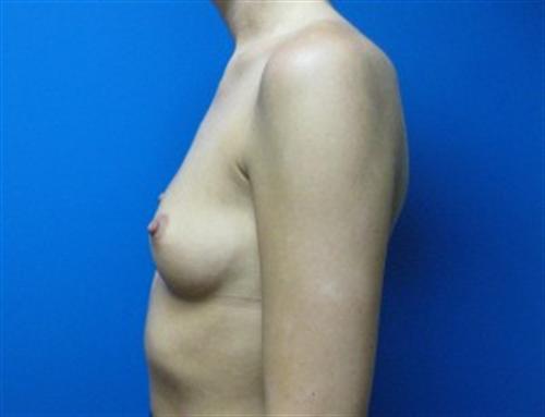 Breast Augmentation Before and After | SGK Plastic Surgery