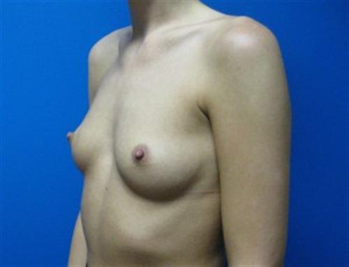 Breast Augmentation Before and After | SGK Plastic Surgery