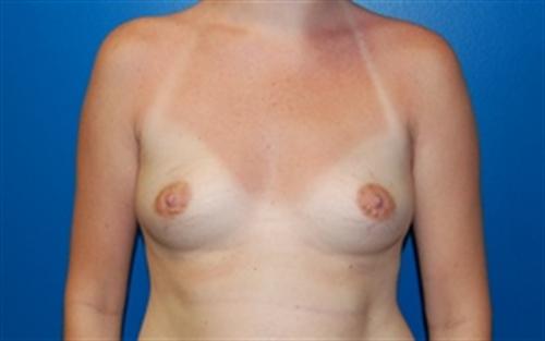 Breast Augmentation Before and After | SGK Plastic Surgery