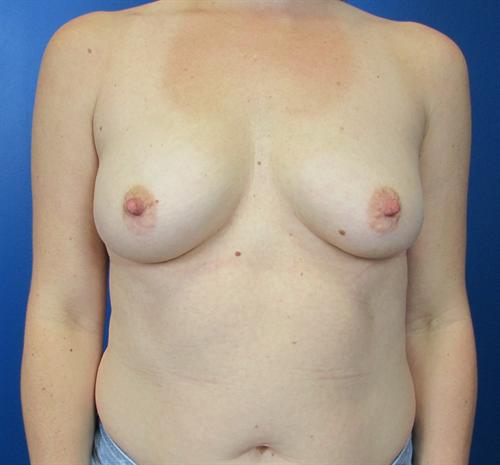 Breast Augmentation Before and After | SGK Plastic Surgery