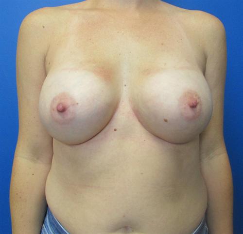 Breast Augmentation Before and After | SGK Plastic Surgery