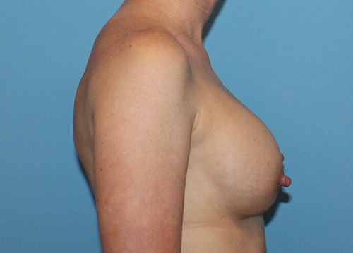 Breast Implant Exchange Before and After | SGK Plastic Surgery