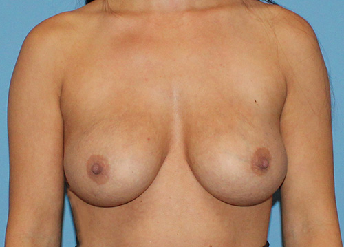 Breast Implant Exchange Before and After | SGK Plastic Surgery