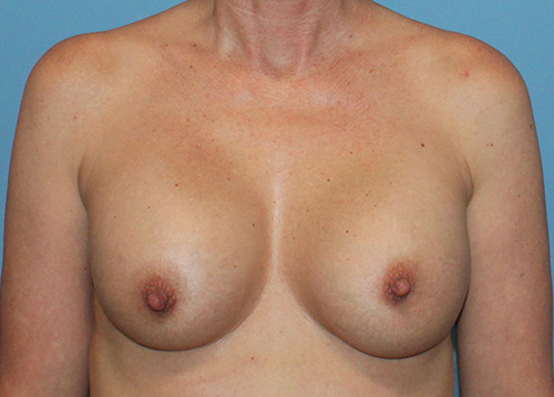 Breast Implant Exchange Before and After | SGK Plastic Surgery