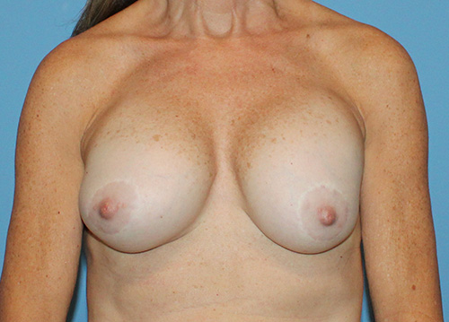 Breast Implant Exchange Before and After | SGK Plastic Surgery