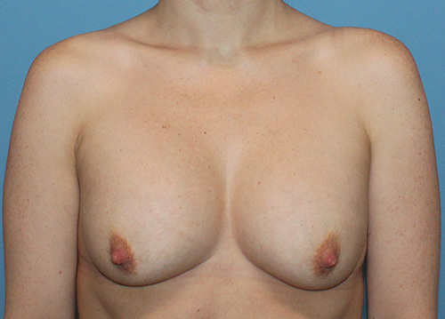 Breast Implant Exchange Before and After | SGK Plastic Surgery