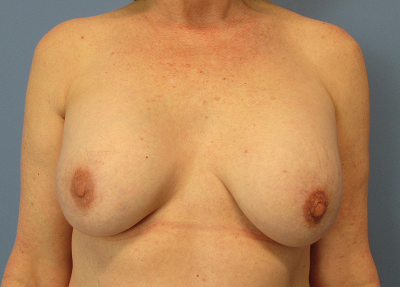 Breast Implant Exchange Before and After | SGK Plastic Surgery