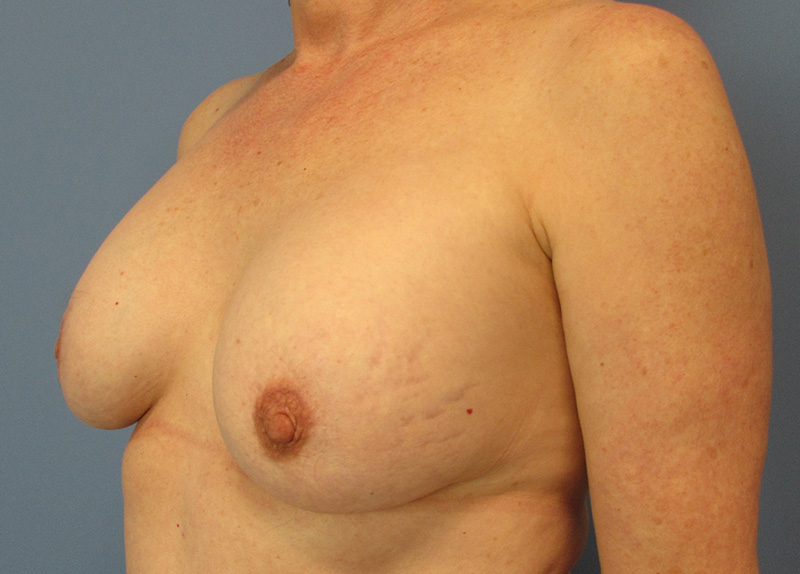 Breast Implant Exchange Before and After | SGK Plastic Surgery