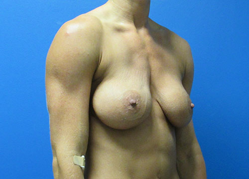 Breast Implant Exchange Before and After | SGK Plastic Surgery