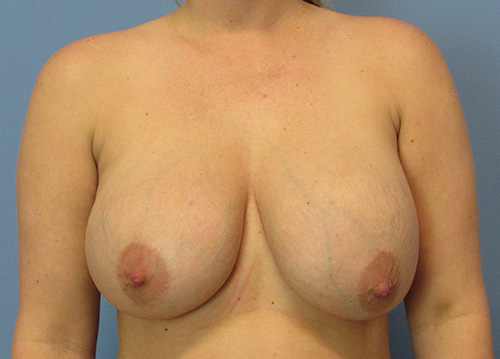 Breast Implant Exchange Before and After | SGK Plastic Surgery