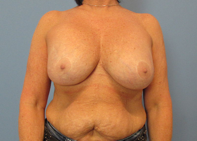 Breast Implant Exchange Before and After | SGK Plastic Surgery