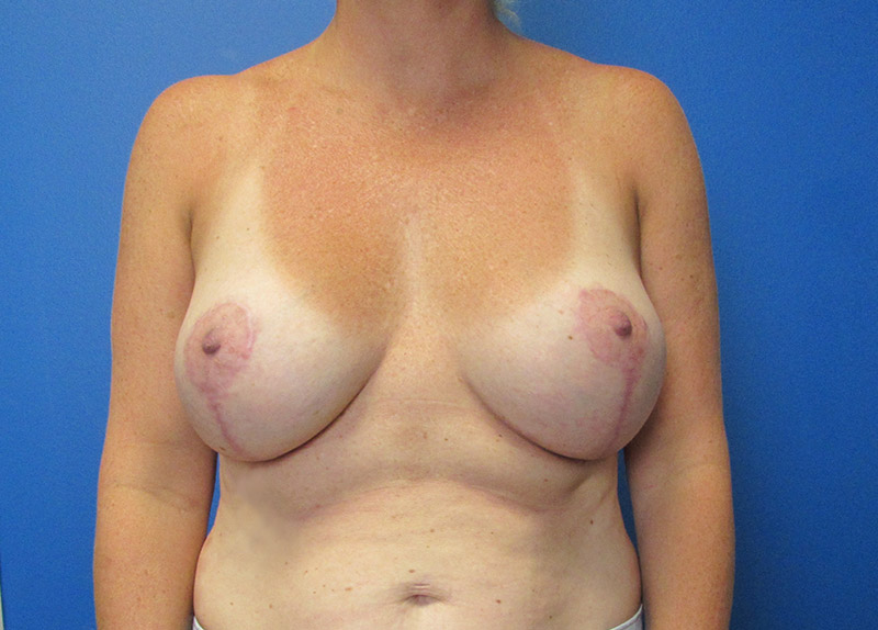 Breast Implant Exchange Before and After | SGK Plastic Surgery