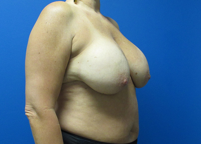 Breast Implant Exchange Before and After | SGK Plastic Surgery