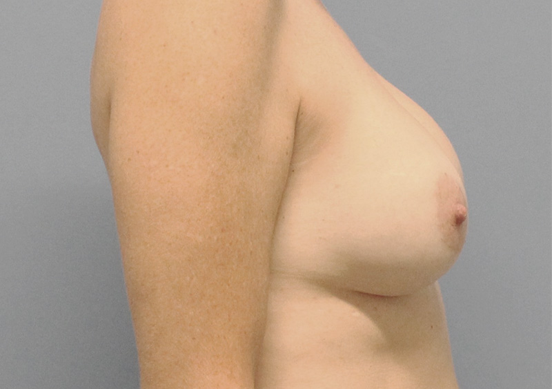 Breast Implant Removal Before and After | SGK Plastic Surgery