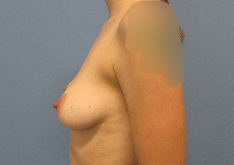 Breast Implant Removal Before and After | SGK Plastic Surgery