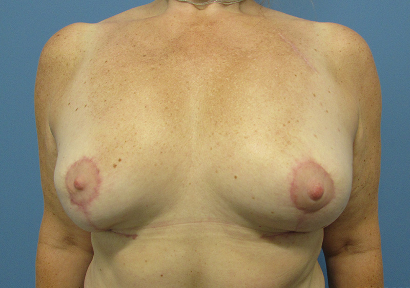 Breast Implant Removal Before and After | SGK Plastic Surgery