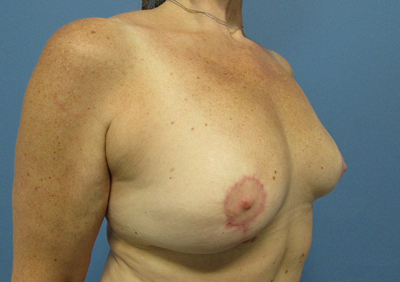 Breast Implant Removal Before and After | SGK Plastic Surgery