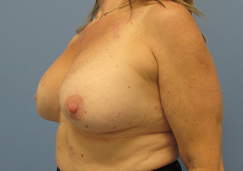 Breast Implant Removal Before and After | SGK Plastic Surgery