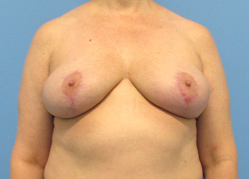 Breast Implant Removal Before and After | SGK Plastic Surgery